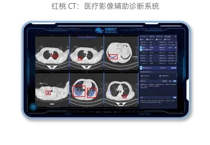 红桃 CT：医疗影像辅助诊断系统